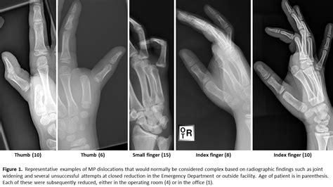 AAHS Does Irreducibility Always Mean A Complex Metacarpophalangeal