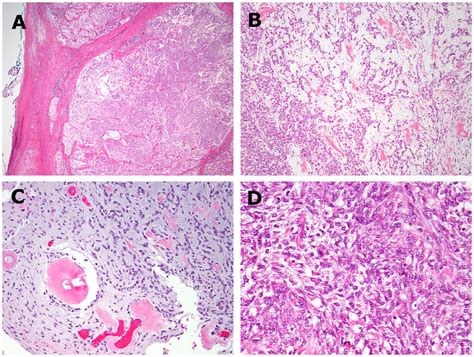 Histologic Findings Of EWSR1 CREM Positive Index Case 1 A B The