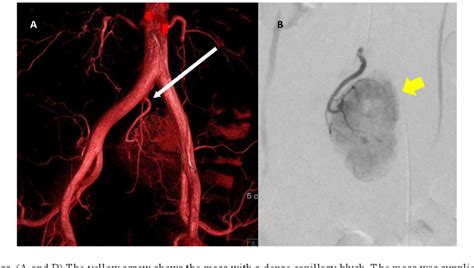 Figure From Surgical Resection For Pelvic Retroperitoneal Castleman S