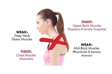 Common Problems Why Does My Neck Hurt Fine Form Physiotherapy