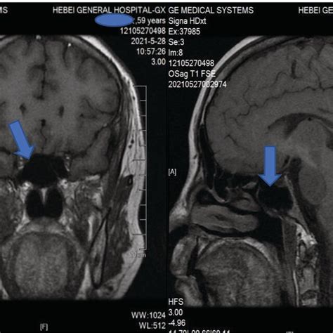 Pituitary Magnetic Resonance Imaging Showing Empty Sella Download