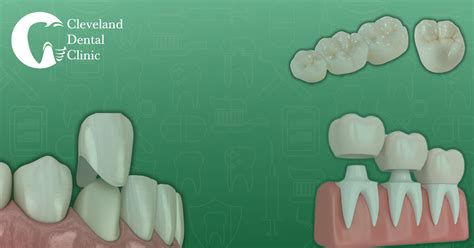 Everything You Need To Know About Dental Crowns Blog