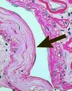 Hypertensive nephropathy pathophysiology - wikidoc