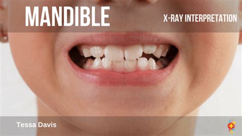 Mandible x-rays