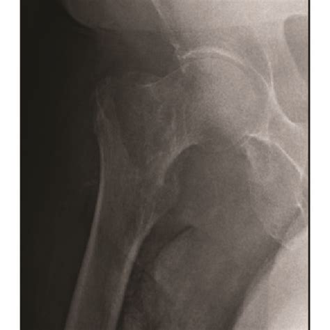 Preoperative Anteroposterior A And Lateral B Radiographs Of The