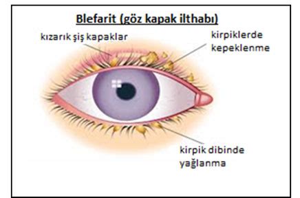 Blefarit Tedavisi Fiyatlar Prof Dr G Khan G Lkilik