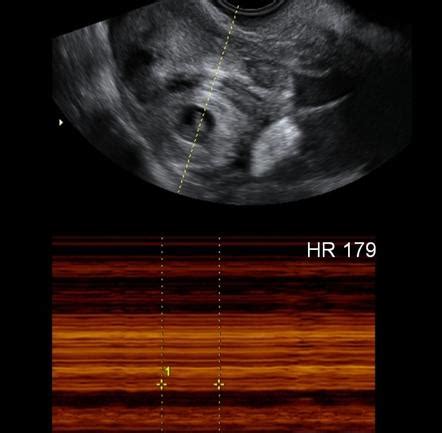 6 Week Ultrasound Heartbeat