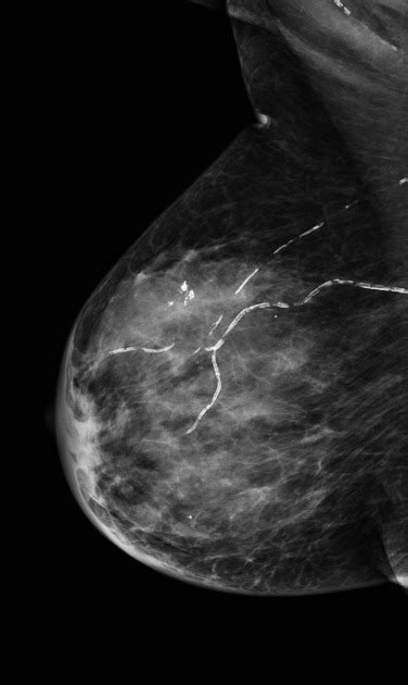 Inflammatory Breast Cancer Mammogram