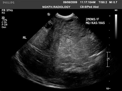 Hepatoblastoma ultrasound - wikidoc