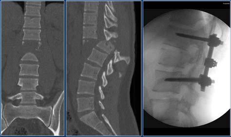 The Radiology Assistant Spine Fractures Tlics Classification