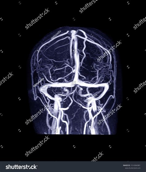 Mrv Brain Magnetic Resonance Venography Brain Stock Photo