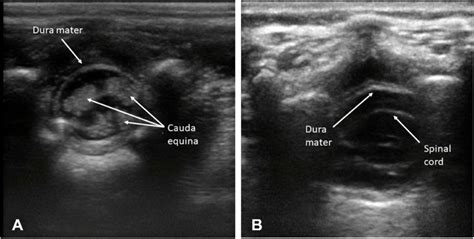 Ultrasound imaging in the transverse view of neonatal spine. (A) Below ...