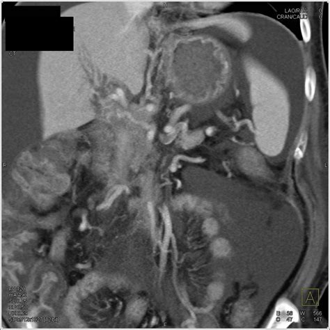 Pancreatic Cancer Encases The Portal Vein And Superior Mesenteric Vein