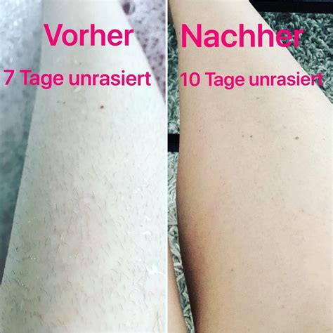 Dauerhafte Haarentfernung Vorher Nachher Dauerhafte Haarentfernung