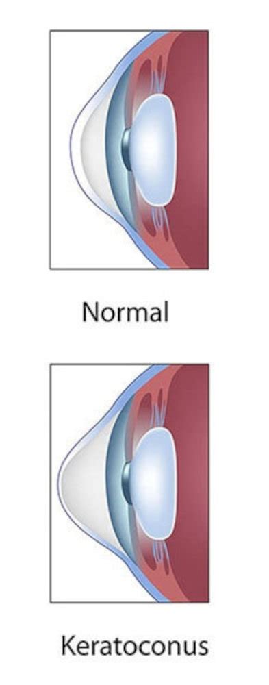 Keratoconus Treatment Birmingham Laser Eye Surgery