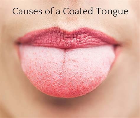 Learn the causes of a coated tongue - Dr Chauvin