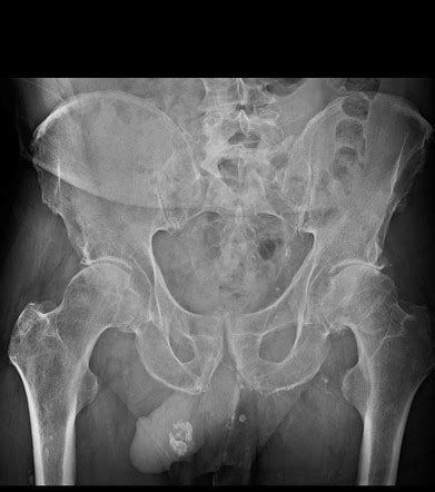 Throckmorton Sign Pelvis Radiology Reference Article Radiopaedia Org