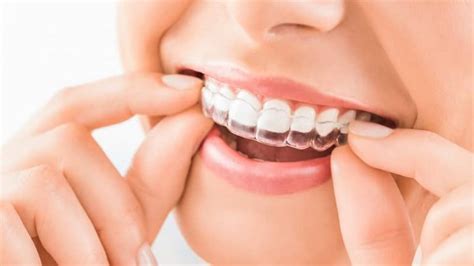 Qu Son Los Ataches En Invisalign Y Para Qu Sirven