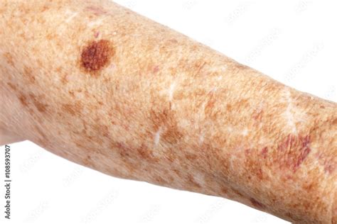 Female Senior Citizen Arm With Age Spots Also Known As Liver Spots Solar Lentigo Lentigo