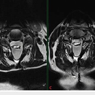 Preoperative MRI Of The Cervical Spine With Mid Sagittal View A And