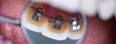 A Comprehensive Guide To How Different Types Of Braces Work