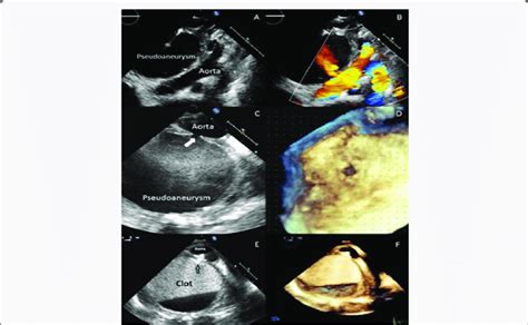 A F D Transthoracic Echocardiography A And B Suprasternal View