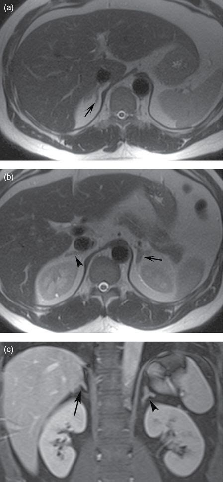 Adrenal Gland Mri