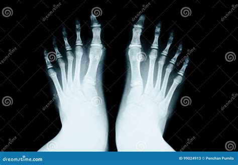 X-ray Of The Foot. Human Bones. Real X-ray Leg, Side View. Royalty-Free ...