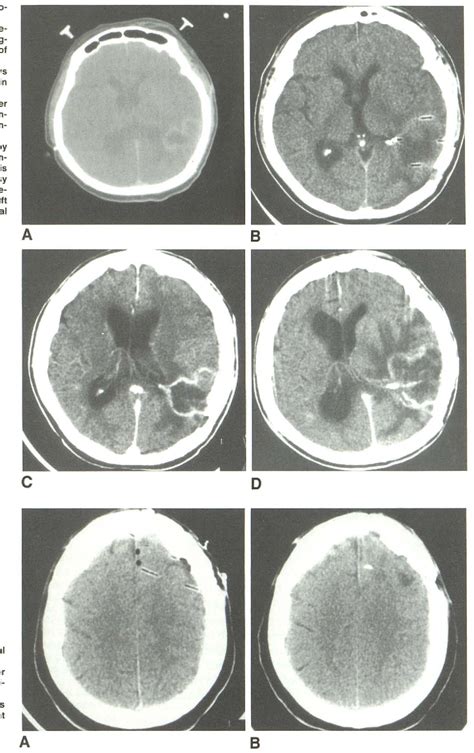 Figure 2 From Therapy For Primary Malignant Brain Tumors Early Ct Findings After Interstitial