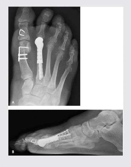 Plain Radiographs At Months Follow Up Standing Anteroposterior A