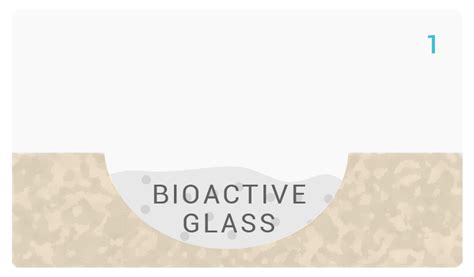 Bioactive Glass Noraker