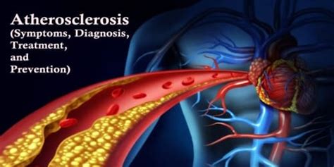 Atherosclerosis Symptoms Diagnosis Treatment And Prevention