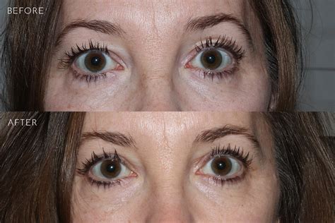 Eyelid Lift Before And After Photos Kirkland Bellevue Marina Park