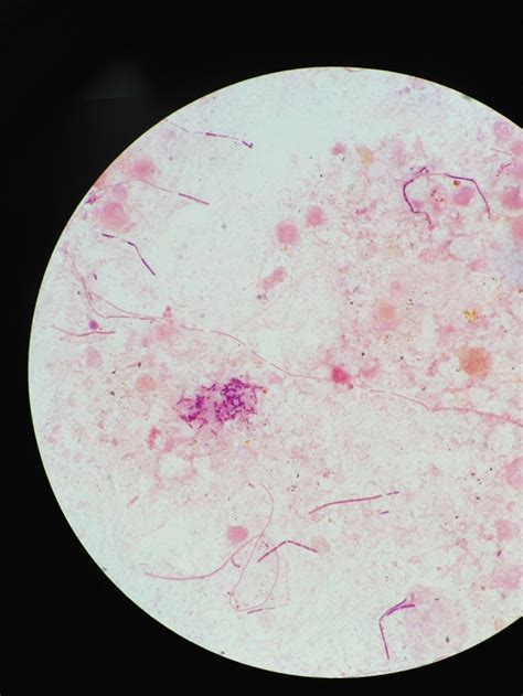 microaerophilic: following up on the pleural... | Laboratory Science Review