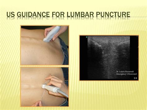 Ppt Ultrasound Guided Lumbar Puncture Powerpoint Presentation Id