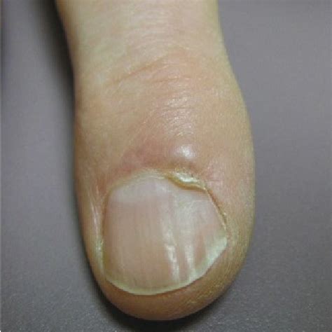 Digital Mucous Cyst At The Second Digit Within The Proximal Nail Fold