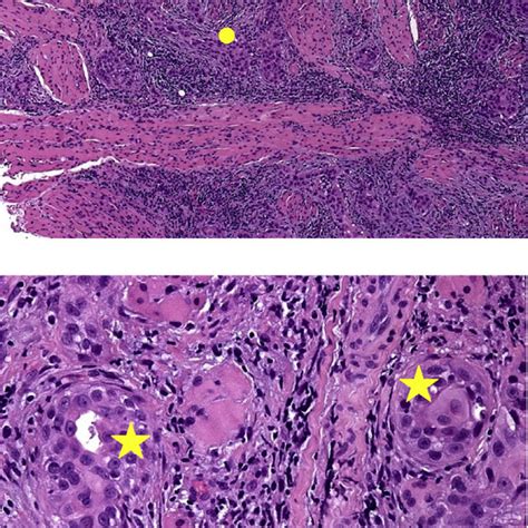 The Metastatic Node Consists Of A Well Differentiated Squamous Cell