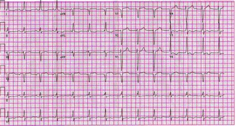 Junctional rhythm - wikidoc