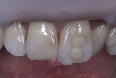 Single Tooth Composite Restoration Mimicking Nature