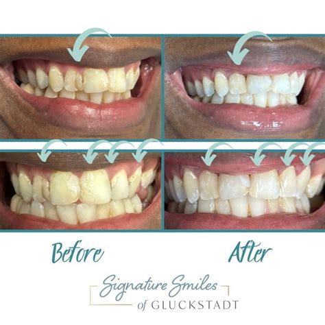 Before And After Signature Smiles Of Gluckstadt