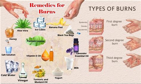 Natural Health And Beauty Home Remedies For Burns Burns Treatment