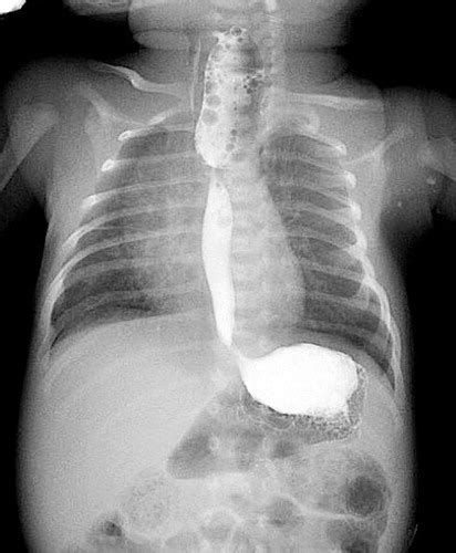 Esophageal Atresia X Ray