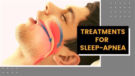 Treatments For Sleep Apnea Youtube