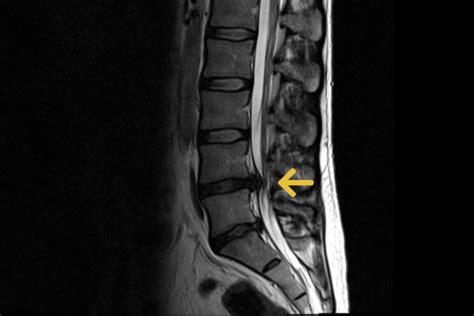 Bandscheibenvorfall Gemeinschaftspraxis F R Neurochirurgie