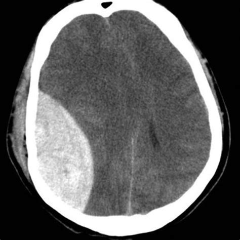 Axial Noncontrast Head Ct Scan Showing Hyperdensity In The Globus Download Scientific Diagram