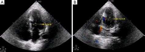 2d Echocardiography Apical Four Chamber View And Color Doppler Showing