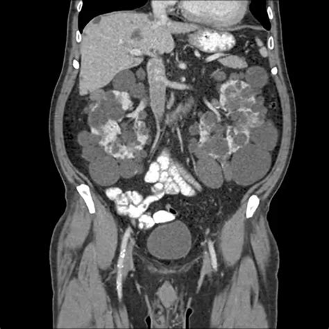 Procedure of CT Pelvis/Abdomen - Ganesh Diagnostic