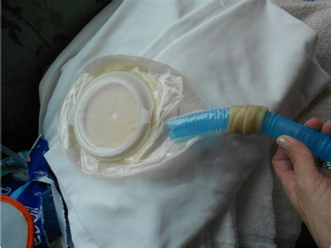 High Output Fistula And Ostomy Effluent Containment Fistula Solution