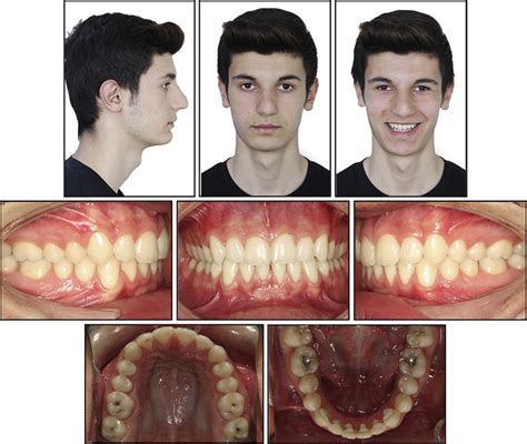 Combined Orthodontic Orthopedic Treatment Of An Adolescent Class Ii