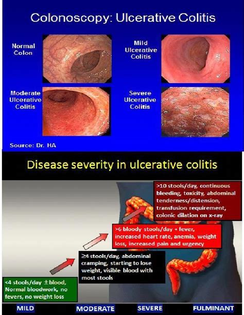 Diverticulitis Signs Remedies Signs And Signs And Methods To Treat Or